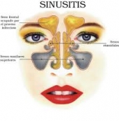 Atendemos sinusitis - Dr. Alejandro Ortiz Domínguez - Otorrinolaringólogo y Cirugía Facial