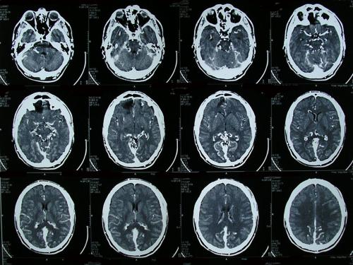 Tp Qué Son Las Malformaciones Cerebrales Neurocirujano Dr Abraham García Nieva En Puebla 6885