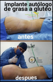  - Cirugía estética y Bariatría en Puebla - Dr. Mario Salazar Olivares
