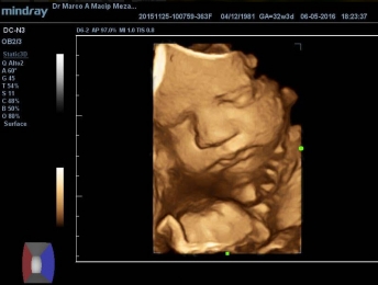 Tp Fotos De Conoce Hoy A Tu Bebe Con El Ultrasonido 3d Ginecologia Y Obstetricia Dr Marco Antonio Macip Meza Puebla Todopuebla Com