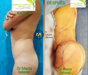 Implante autólogo de grasa a glúteo - Cirugía estética y Bariatría en Puebla - Dr. Mario Salazar Oli...