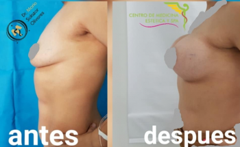 Asimetría mamaria implante de gel silicón cohesivo - Cirugía estética y Bariatría en Puebla - Dr. Ma...